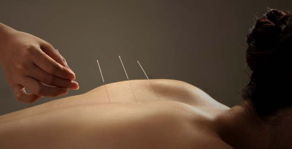 acupunture
